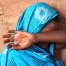 A girl with fistula awaits repair from camps supported by UNFPA.jpg